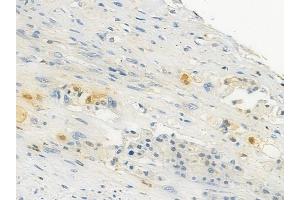 ABIN6257574 and ABIN6274141 at 1/100 staining human lung squamous cell carcinoma by IHC-P. (ZNF682 anticorps  (N-Term))