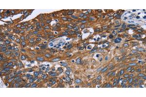 Immunohistochemistry of paraffin-embedded Human cervical cancer tissue using FCGR3A Polyclonal Antibody at dilution 1:40 (FCGR3A anticorps)