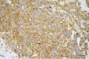 Immunohistochemistry was performed on paraffin-embedded human breast carcinoma using GAPDH antibody (ABIN7798768), 1:500). (Recombinant GAPDH anticorps)