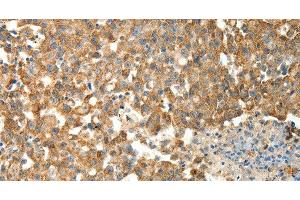 Immunohistochemistry of paraffin-embedded Human breast cancer using PRDX3 Polyclonal Antibody at dilution of 1:50 (Peroxiredoxin 3 anticorps)