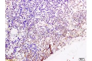 Formalin-fixed and paraffin embedded human endometrium carcinoma tissue labeled with Anti-Cyclin G Polyclonal Antibody, Unconjugated (ABIN685837) at 1:200 followed by conjugation to the secondary antibody and DAB stainin (Cyclin G1 anticorps  (AA 181-295))