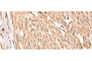 Immunohistochemistry of paraffin-embedded Human cervical cancer tissue using HSF4 Polyclonal Antibody at dilution of 1:55(x200) (HSF4 anticorps)