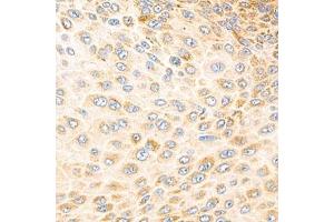 Immunohistochemistry analysis of paraffin-embedded human esophageal cancer using Torsin A (ABIN7075942) at dilution of 1: 800