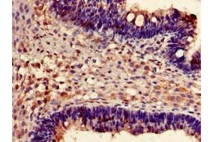 Immunohistochemistry of paraffin-embedded human ovarian cancer using ABIN7153147 at dilution of 1:100