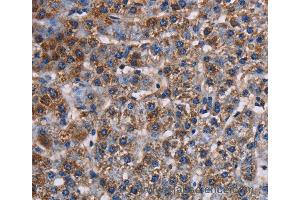 Immunohistochemistry of Human lung cancer using KCNK1 Polyclonal Antibody at dilution of 1:50 (KCNK1 anticorps)