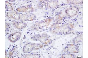 Formalin-fixed and paraffin embedded human gastric cancer labeled with Anti-Phospho-eNOS (Ser1177)Polyclonal Antibody, Unconjugated  at 1:200 followed by conjugation to the secondary antibody and DAB staining