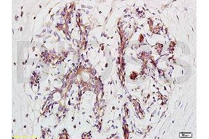 Formalin-fixed and paraffin embedded human breast carcinoma tissue labeled with Anti-BRMS-1 Polyclonal Antibody, Unconjugated (ABIN730933) at 1:200 followed by conjugation to the secondary antibody and DAB staining (BRMS1L anticorps  (AA 151-246))