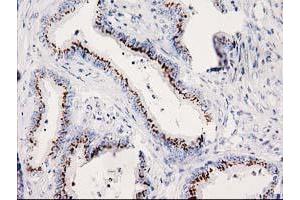 Immunohistochemical staining of paraffin-embedded Adenocarcinoma of Human colon tissue using anti-SOCS3 mouse monoclonal antibody. (SOCS3 anticorps)