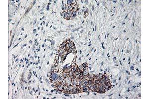 Immunohistochemical staining of paraffin-embedded Adenocarcinoma of Human breast tissue using anti-APBB3 mouse monoclonal antibody.