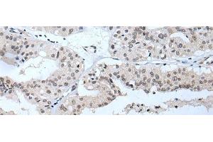 Immunohistochemistry of paraffin-embedded Human liver cancer tissue using TBX1 Polyclonal Antibody at dilution of 1:40(x200)