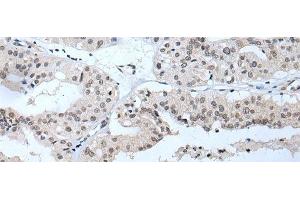 Immunohistochemistry of paraffin-embedded Human liver cancer tissue using TBX1 Polyclonal Antibody at dilution of 1:40(x200) (T-Box 1 anticorps)