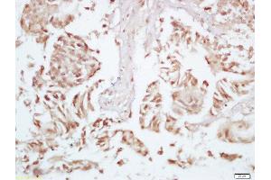 Formalin-fixed and paraffin embedded human colon carcinoma labeled with Rabbit Anti-P70 S6 Kinase beta 2 (Ser370) Polyclonal Antibody, Unconjugated 1:200 followed by conjugation to the secondary antibody and DAB staining (RPS6KB2 anticorps  (pSer370))