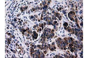 Immunohistochemical staining of paraffin-embedded Carcinoma of Human lung tissue using anti-LGALS3BP mouse monoclonal antibody. (LGALS3BP anticorps)