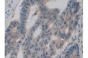 Detection of PKM2 in Human Colorectal cancer Tissue using Polyclonal Antibody to Pyruvate kinase isozymes M2 (PKM2)