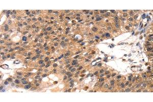 Immunohistochemistry of paraffin-embedded Human breast cancer using TLN1 Polyclonal Antibody at dilution of 1:35