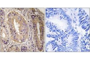 Immunohistochemistry analysis of paraffin-embedded human colon carcinoma tissue, using FAK (Ab-843) Antibody. (FAK anticorps  (AA 809-858))