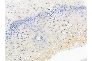 ABIN6255654 and ABIN6267462 at 1/100 staining human cervical carcinoma by IHC-P. (Cyclin D3 anticorps  (pThr283))