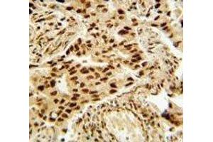 HDAC2 antibody immunohistochemistry analysis in formalin fixed and paraffin embedded human lung carcinoma