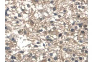 Detection of ALDOA in Human Glioma Tissue using Polyclonal Antibody to Aldolase A, Fructose Bisphosphate (ALDOA)