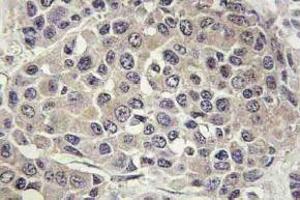 Immunohistochemistry (IHC) analyzes of p-p70 S6 kinase alpha antibody in paraffin-embedded human breast carcinoma tissue. (RPS6KB1 anticorps  (pSer447))