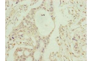 Immunohistochemistry of paraffin-embedded human pancreatic cancer using ABIN7148371 at dilution of 1:100 (C8B anticorps  (AA 55-350))