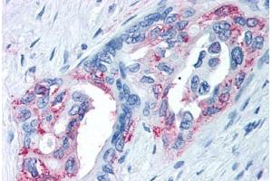 Anti-TRPM8 antibody  ABIN1049436 IHC staining of human prostate carcinoma. (TRPM8 anticorps  (Internal Region))