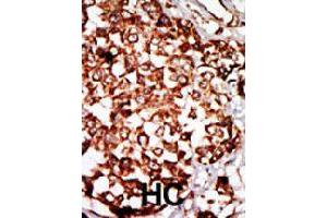 Formalin-fixed and paraffin-embedded human hepatocellular carcinoma tissue reacted with NRBP1 polyclonal antibody  , which was peroxidase-conjugated to the secondary antibody, followed by DAB staining. (NRBP1 anticorps  (N-Term))