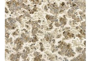ABIN6255351 and ABIN6267196 at 1/100 staining human renal cell carcinoma by IHC-P.