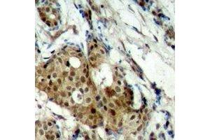 Immunohistochemical analysis of CDK11B staining in human breast cancer formalin fixed paraffin embedded tissue section.
