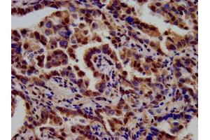 IHC image of ABIN7171895 diluted at 1:700 and staining in paraffin-embedded human lung cancer performed on a Leica BondTM system. (Tetraspanin 9 anticorps  (AA 107-203))