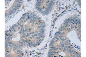 The image on the left is immunohistochemistry of paraffin-embedded Human colon cancer tissue using ABIN7130139(MAGEB4 Antibody) at dilution 1/40, on the right is treated with fusion protein. (MAGEB4 anticorps)