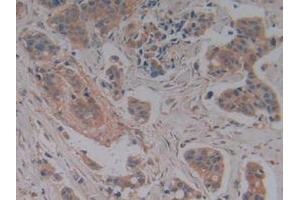 Detection of CFH in Human Breast Cancer Tissue using Polyclonal Antibody to Complement Factor H (CFH)