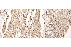 Immunohistochemistry of paraffin-embedded Human prost ate cancer tissue using ATAD3A Polyclonal Antibody at dilution of 1:40(x200) (ATAD3A anticorps)