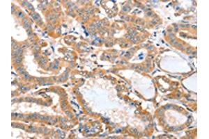 The image on the left is immunohistochemistry of paraffin-embedded Human thyroid cancer tissue using ABIN7128162(ACOT11 Antibody) at dilution 1/25, on the right is treated with fusion protein. (ACOT11 anticorps)