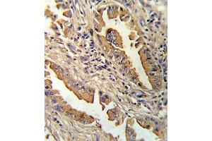 Formalin-fixed and paraffin-embedded human lung carcinoma reacted with IL8 Antibody (C-term), which was peroxidase-conjugated to the secondary antibody, followed by DAB staining. (IL-8 anticorps  (C-Term))