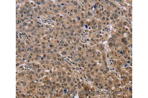 Immunohistochemistry of Human thyroid cancer using KIF25 Polyclonal Antibody at dilution of 1:40 (KIF25 anticorps)