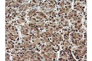 Immunohistochemical staining of paraffin-embedded Carcinoma of Human liver tissue using anti-SAMHD1 mouse monoclonal antibody. (SAMHD1 anticorps)