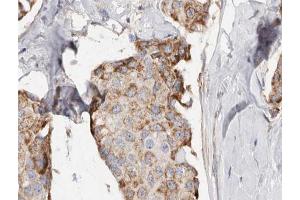 ABIN6266941 at 1/100 staining human Breast cancer tissue sections by IHC-P. (PHLDA2 anticorps  (Internal Region))
