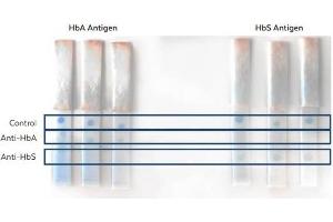 Lateral Flow Results of Anti-HbA (Hemoglobin A) and Anti-HbS (Hemoglobin beta S) Antibodies.