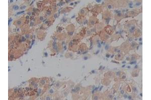DAB staining on IHC-P; Samples: Human Stomach cancer Tissue (Prekallikrein anticorps  (AA 156-364))