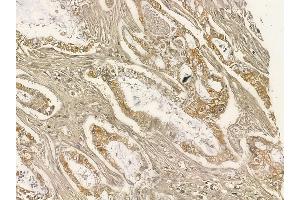 ZFYVE1 Mouse Monoclonal Antibody at 1/100 staining human pancreatic cancer and adjacent non-tumor tissue by IHC-P.