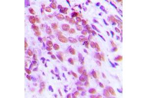 Immunohistochemical analysis of NF-kappaB p65 (pS276) staining in human breast cancer formalin fixed paraffin embedded tissue section. (NF-kB p65 anticorps  (pSer276))