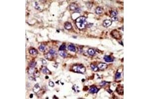 Formalin-fixed and paraffin-embedded human cancer tissue reacted with the primary antibody, which was peroxidase-conjugated to the secondary antibody, followed by DAB staining.