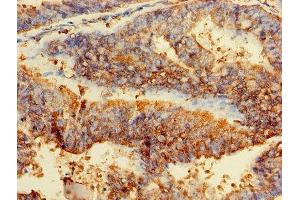 Immunohistochemistry of paraffin-embedded human endometrial cancer using ABIN7153928 at dilution of 1:100