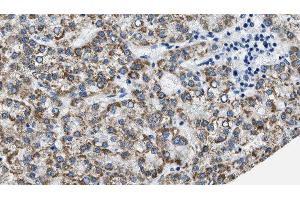 ABIN6275941 at 1/100 staining Human liver cancer tissue by IHC-P. (PTGER3 anticorps  (C-Term))