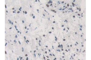 Detection of HNRNPA1 in Human Glioma Tissue using Polyclonal Antibody to Heterogeneous Nuclear Ribonucleoprotein A1 (HNRNPA1)