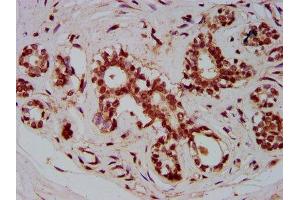 IHC image of ABIN7176088 diluted at 1:800 and staining in paraffin-embedded human breast cancer performed on a Leica BondTM system.