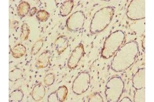 Immunohistochemistry of paraffin-embedded human colon cancer using ABIN7146794 at dilution of 1:100 (CEACAM4 anticorps  (AA 36-155))