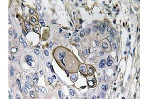 Immunohistochemical analysis of paraffin-embedded human lung cancer tissue using AQP5 polyclonal antibody . (Aquaporin 5 anticorps)