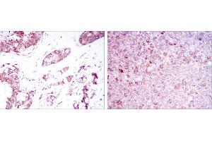 Immunohistochemical analysis of paraffin-embedded breast cancer tissues (left) and tonsil tissues (right) using BMPR2 mouse mAb with DAB staining.